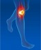 Ginocchiera per infiammazione ginocchio e problemi alla rotula Epitact